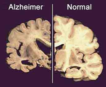 Cerebro normal y cerebro con alzheimer