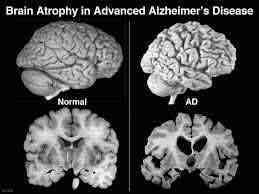 Cerebro sano y cerebro con alzheimer